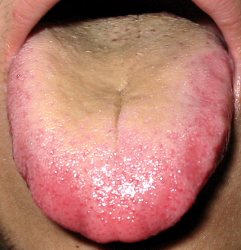 舌診の例　湿熱証の舌